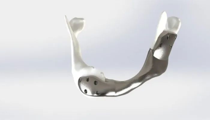 首个3D打印钛颌骨成功移植到癌症患者身上