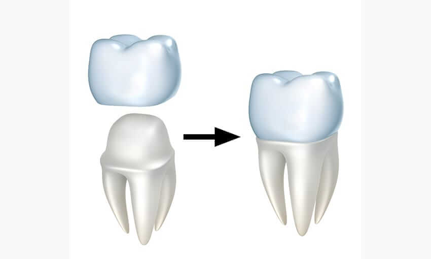 研究发现3D打印更适合制作牙冠