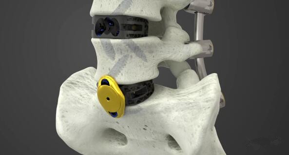 骨科巨头全面推出3D打印产品